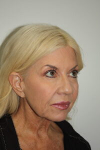 Female Facelift Patient 66 - Before - 1 Thumbnail