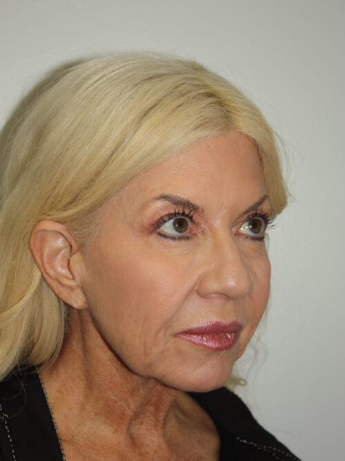 Female Facelift Patient 66 - Before - 1