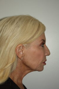 Female Facelift Patient 66 - Before - 3 Thumbnail