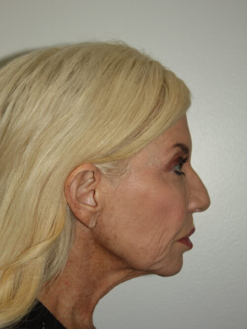 Female Facelift Patient 66 - Before - 3