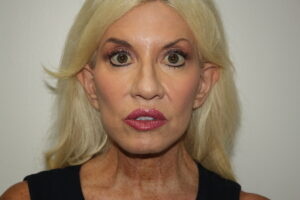 Female Facelift Patient 66 - After - 2 Thumbnail