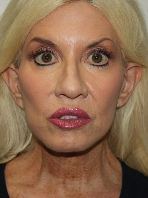 Female Facelift Patient 66 - After - 2