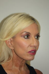 Female Facelift Patient 66 - After - 1 Thumbnail