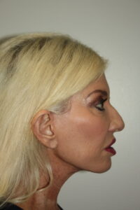 Female Facelift Patient 66 - After - 3 Thumbnail