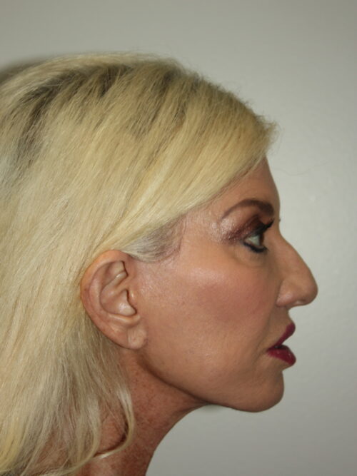 Female Facelift Patient 66 - After - 3