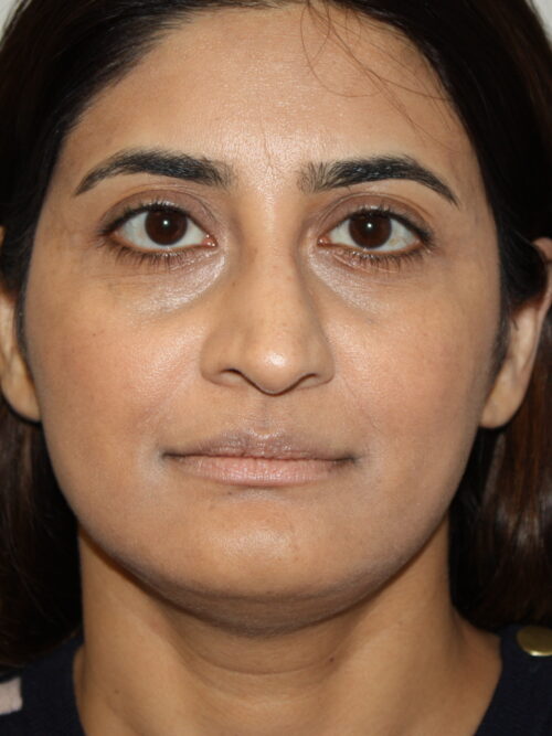 Rhinoplasty Patient 38 - Before - 1