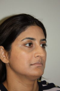 Rhinoplasty Patient 38 - Before - 2 Thumbnail