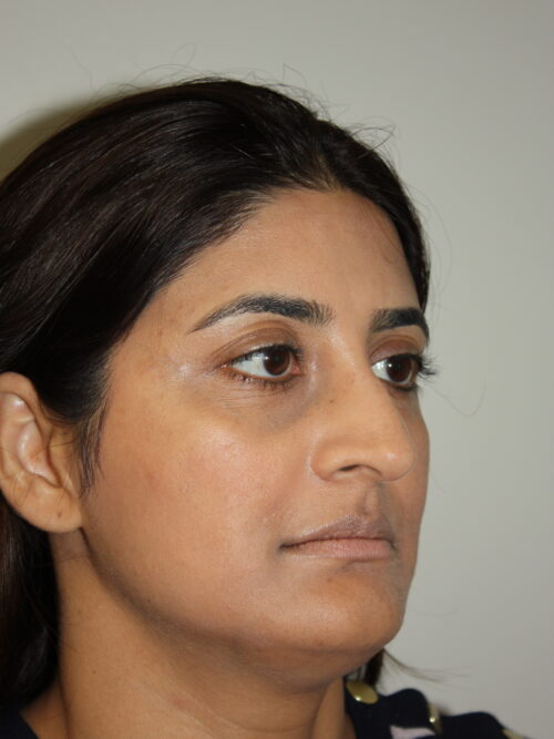 Rhinoplasty Patient 38 - Before - 2