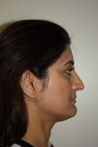 Rhinoplasty Patient 38 - Before - 3 Thumbnail