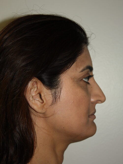 Rhinoplasty Patient 38 - Before - 3