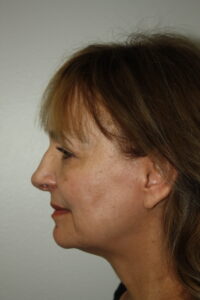 Female Facelift Patient 62 - Before - 3 Thumbnail