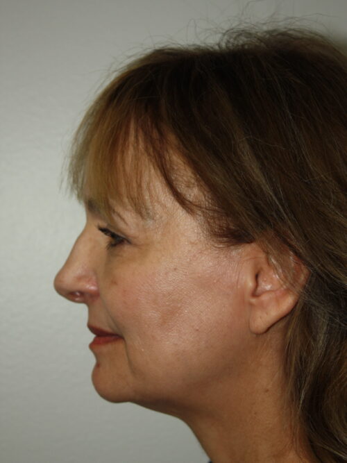 Female Facelift Patient 62 - Before - 3