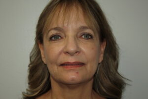 Female Facelift Patient 62 - Before - 2 Thumbnail