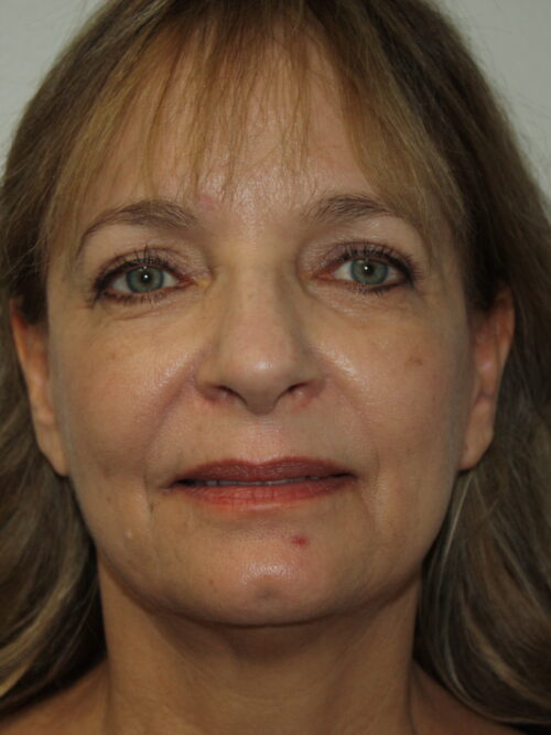 Female Facelift Patient 62 - Before - 2