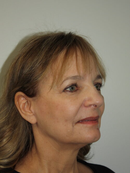 Female Facelift Patient 62 - Before - 1