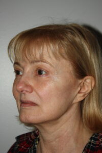 Female Facelift Patient 63 - Before - 1 Thumbnail