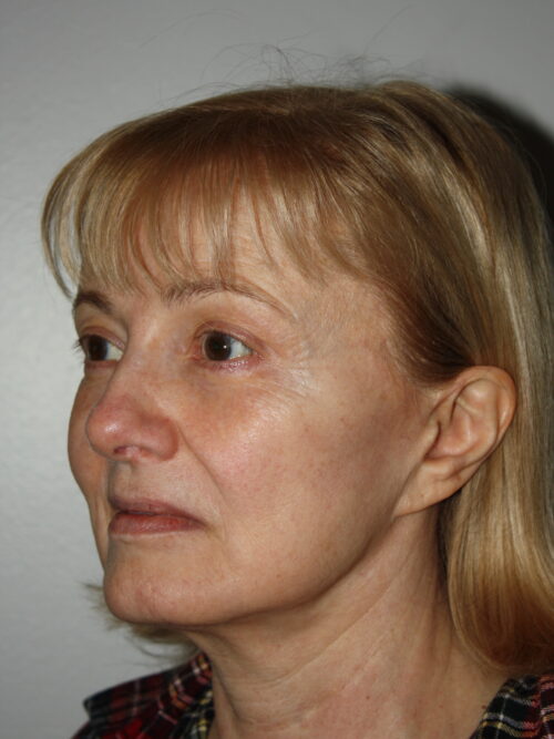 Female Facelift Patient 63 - Before - 1