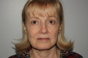 Female Facelift Patient 63 - Before - 2 Thumbnail