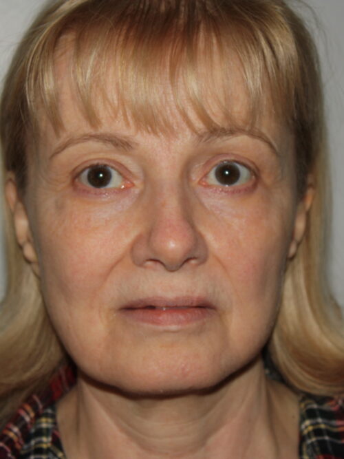 Female Facelift Patient 63 - Before - 2