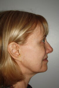 Female Facelift Patient 63 - Before - 3 Thumbnail