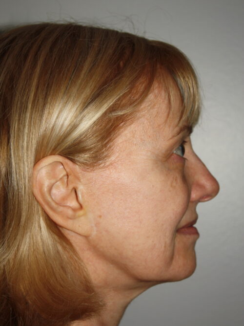 Female Facelift Patient 63 - Before - 3