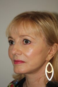 Female Facelift Patient 63 - After - 1 Thumbnail