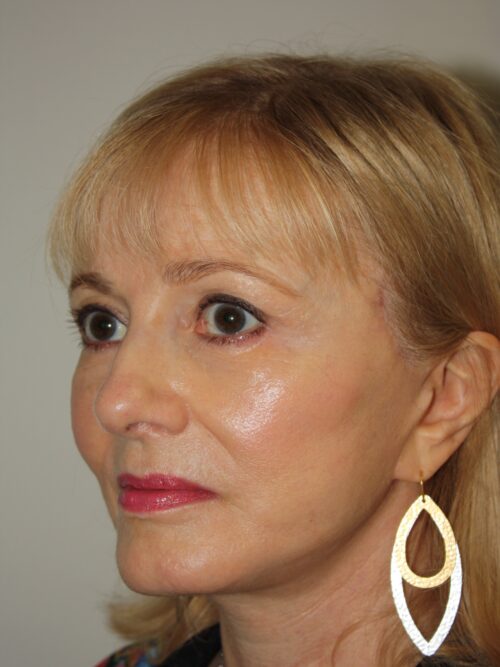 Female Facelift Patient 63 - After - 1