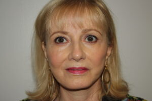 Female Facelift Patient 63 - After - 2 Thumbnail