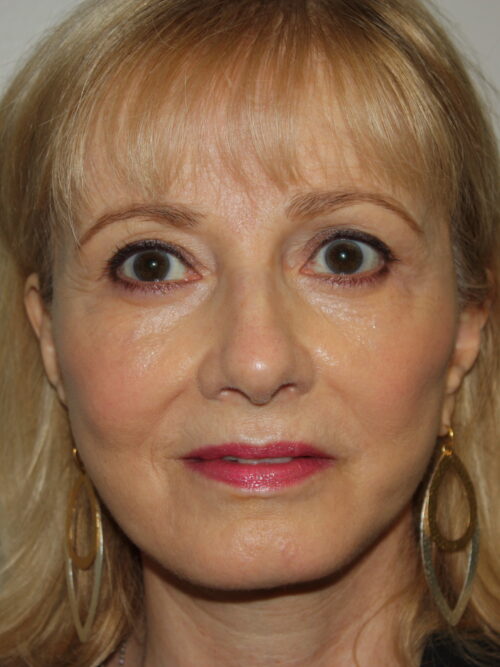 Female Facelift Patient 63 - After - 2