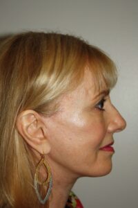 Female Facelift Patient 63 - After - 3 Thumbnail