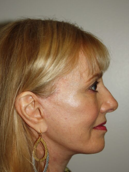 Female Facelift Patient 63 - After - 3