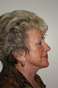 Female Facelift Patient 64 - After - 2 Thumbnail