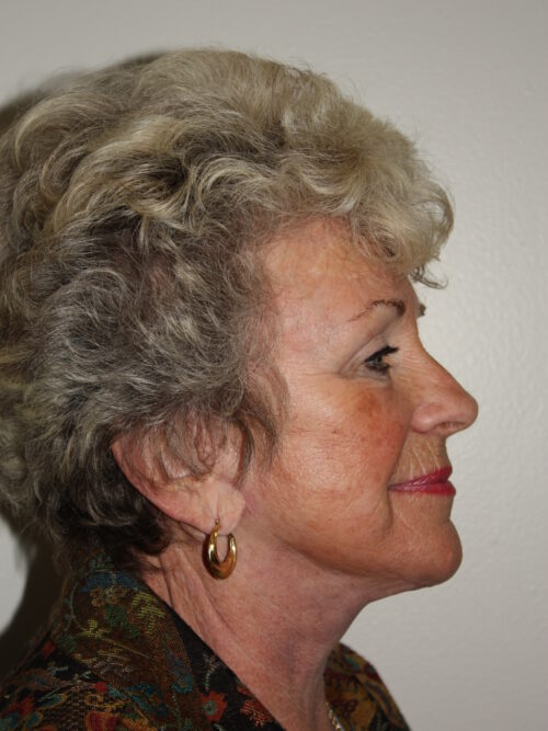 Female Facelift Patient 64 - After - 2