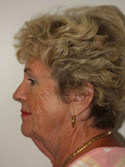 Female Facelift Patient 64 - Before - 4