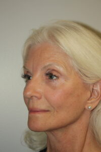 Female Facelift Patient 68 - After - 1 Thumbnail