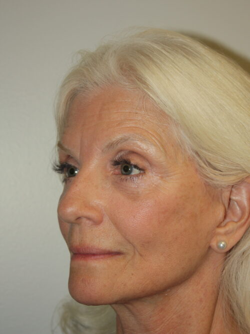 Female Facelift Patient 68 - After - 1