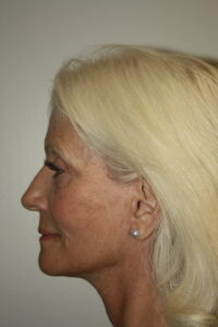 Female Facelift Patient 68 - After - 3 Thumbnail