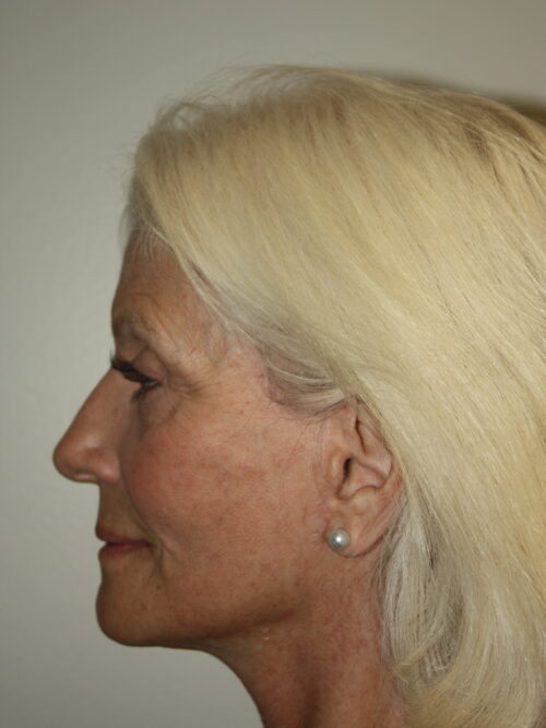 Female Facelift Patient 68 - After - 3