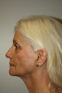 Female Facelift Patient 68 - Before - 3 Thumbnail