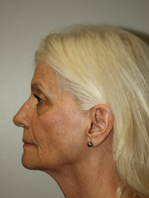 Female Facelift Patient 68 - Before - 3