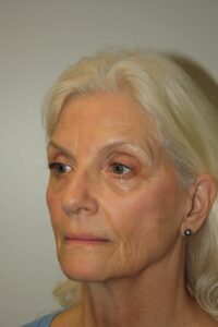 Female Facelift Patient 68 - Before - 1 Thumbnail