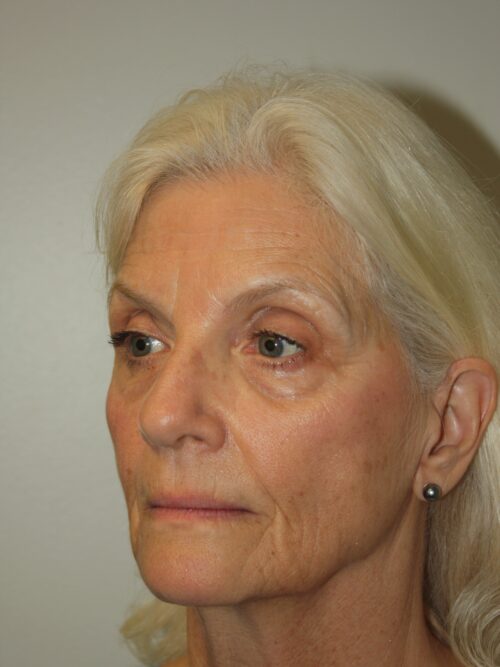 Female Facelift Patient 68 - Before - 1