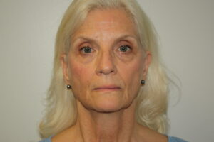 Female Facelift Patient 68 - Before - 2 Thumbnail