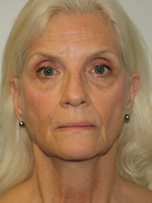 Female Facelift Patient 68 - Before - 2