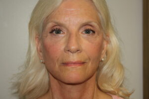 Female Facelift Patient 68 - After - 2 Thumbnail