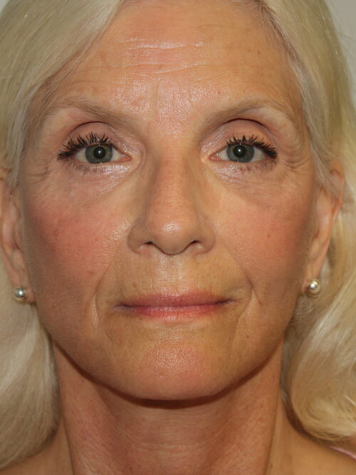 Female Facelift Patient 68 - After - 2