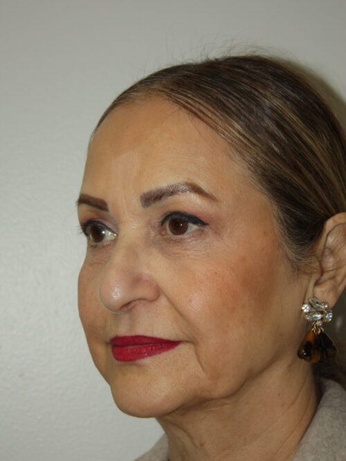 Female Facelift Patient 69 - Before - 1