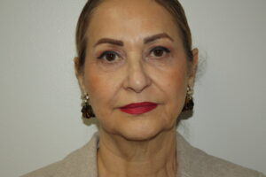 Female Facelift Patient 69 - Before - 2 Thumbnail