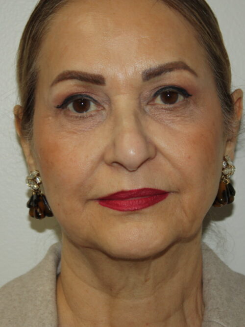 Female Facelift Patient 69 - Before - 2