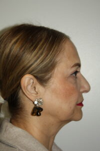 Female Facelift Patient 69 - Before - 3 Thumbnail